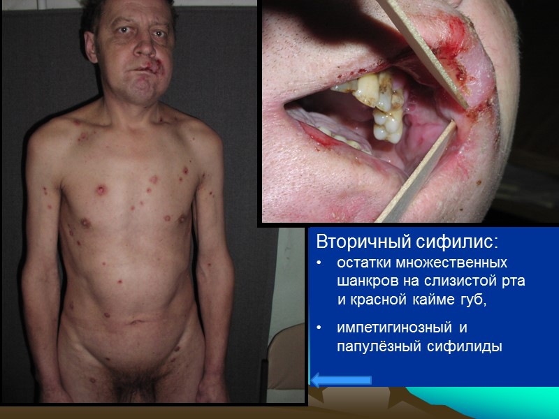 Вторичный сифилис: остатки множественных шанкров на слизистой рта  и красной кайме губ, импетигинозный